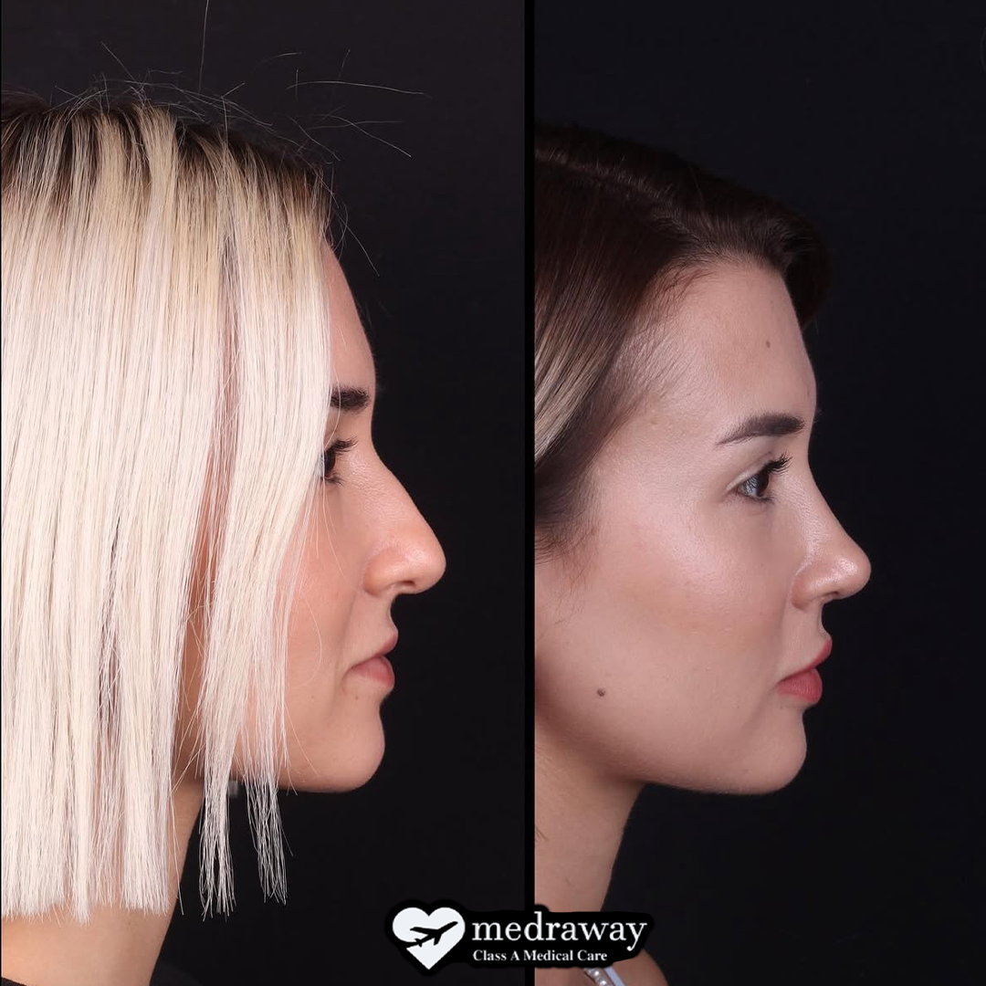 RHINOPLASTY
