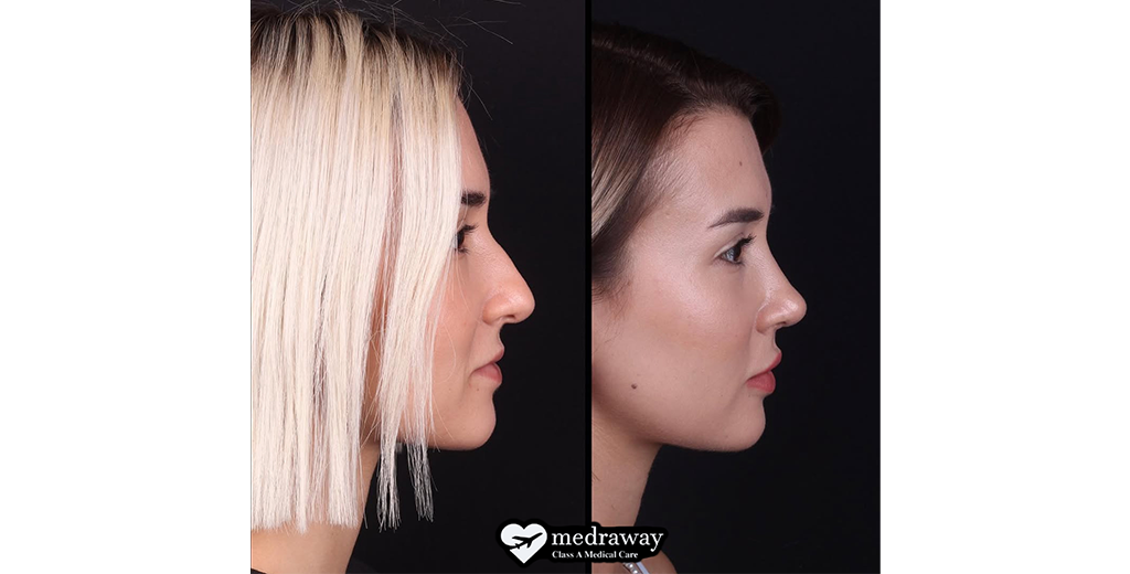 Rhinoplasty
