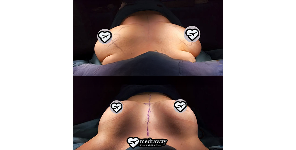 Breast Lifting (Mastopexy)