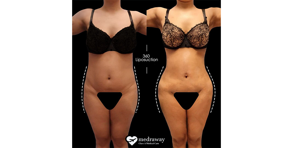 360 Liposuction