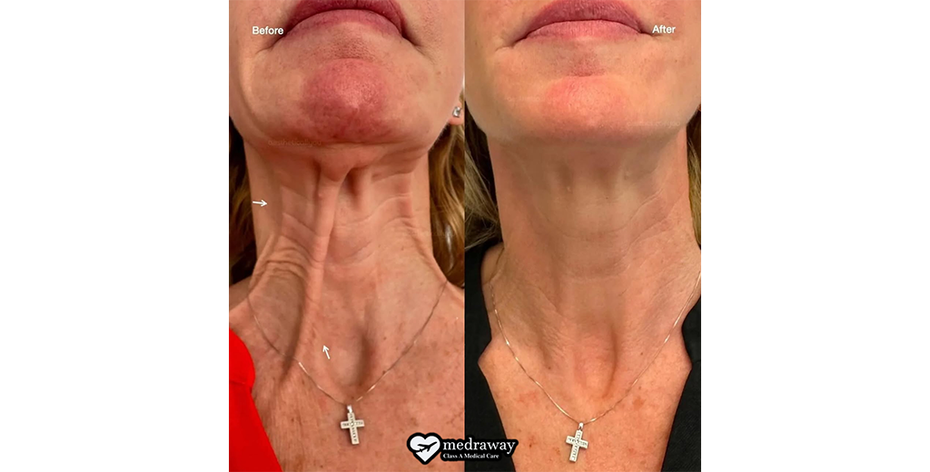 Neck Lift 