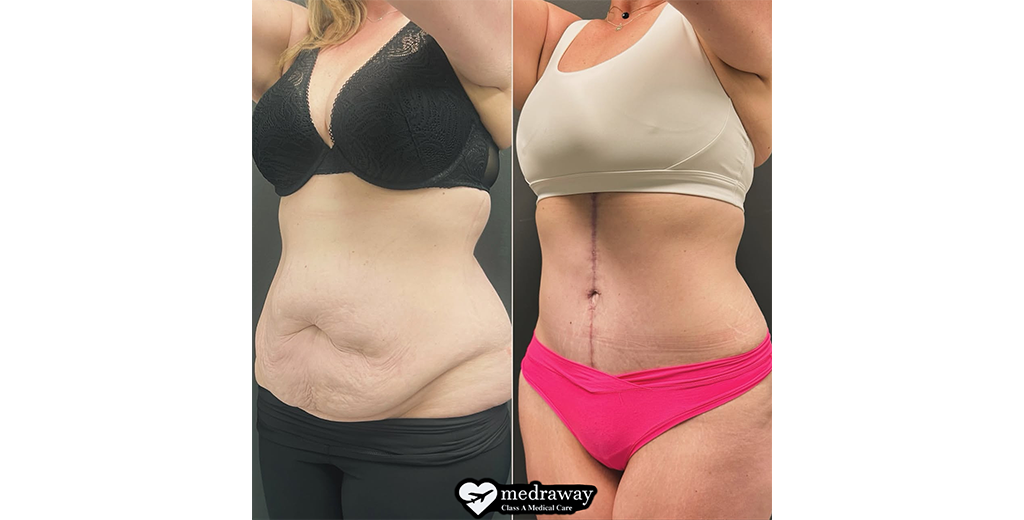 Fleur de Lis Tummy Tuck